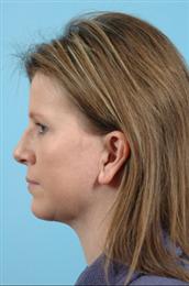 Side View After Facial Rejuvenation Procedures