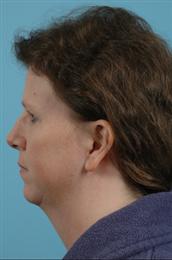 Side View Before Facial Rejuvenation Procedures