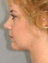 Side View After Neck Lift