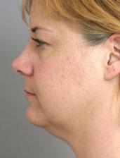 Side View Before Neck Lift