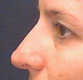 Left Side After Nose Reshaping