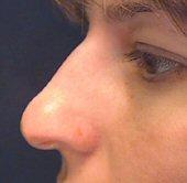 Left Side Before Nose Reshaping