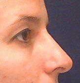 Right Side After Rhinoplasty