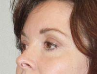 Oblique After Eyelid Surgery