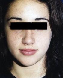 Front View After Rhinoplasty