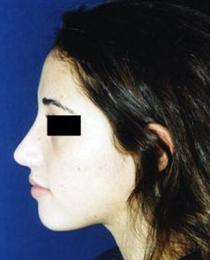 Left Side View After Rhinoplasty