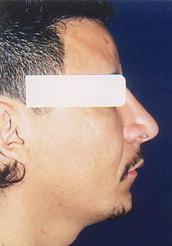 Side View After Rhinoplasty