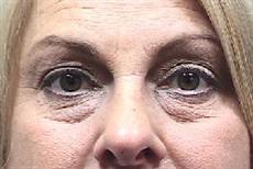 Front View Before Blepharoplasty