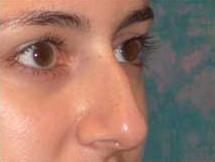Oblique View Before Rhinoplasty