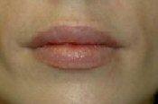 Front View After Lip Augmentation