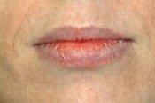 Front View Before Lip Augmentation