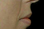 After Lip Augmentation Side View