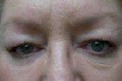 Front View Before Blepharoplasty