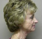 Side view after Neck-lift and Face-lift