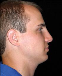 After Nose Reshaping Side View