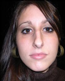 Front View Before Rhinoplasty