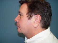 Side After Chin Augmentation