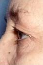 Side View Before Blepharoplasty