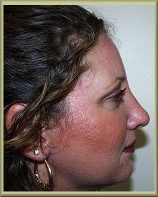 Front View After Rhinoplasty