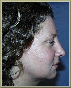 Front View Before Rhinoplasty