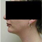 Side After Chin Augmentation
