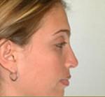 Right Side View After Rhinoplasty/Septoplasty
