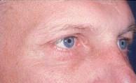 Oblique View After Eyelid Surgery