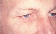 Oblique View Before Eyelid Surgery