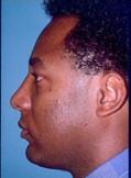 Side View After Neck Liposuction