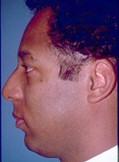 Side View Before Chin Augmentation