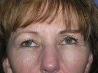 Front Before Facelift and Blepharoplasty