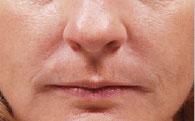 Front after Juvederm® Injections