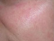 Side after rosacea treatment