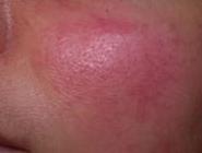 Side before rosacea treatment
