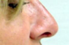 Side View After Rhinoplasty