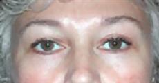 Front View After Blepharoplasty