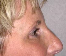 Right side after browlift and blepharoplasty