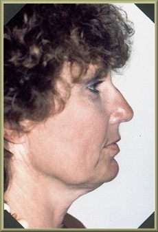 Side View Before Blepharoplasty