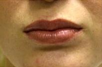 Lip Augmentation