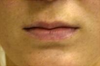 Lip Augmentation