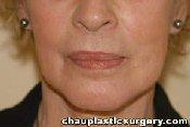 Laser Skin Resurfacing Removes Wrinkles