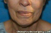 Laser Skin Resurfacing Removes Wrinkles