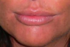 Lip Augmentation