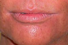 Lip Augmentation