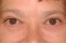 Eyelid Lift Creates Youthful Look