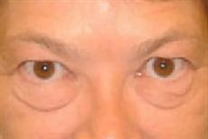 Eyelid Lift Creates Youthful Look