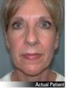 Facelift on 55 Year-Old Female