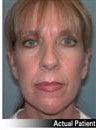 Facelift on 55 Year-Old Female