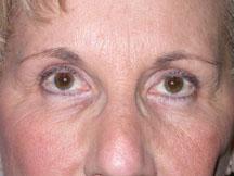 Browlift and Blepharoplasty