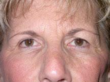 Browlift and Blepharoplasty